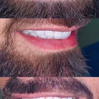 کامپوزیت زیبایی و لمینت دندان(جرمگیری رایگان)