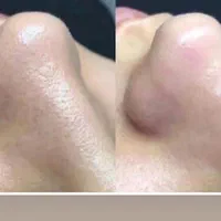 پاکسازی پوست  (فشیال)