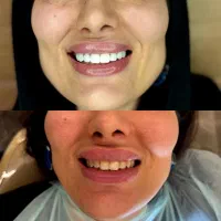 کامپوزیت دندان با طرح اقساطی الماس ، چک ، وام|خدمات آرایشگری و زیبایی|محمدیه-قزوین, |دیوار