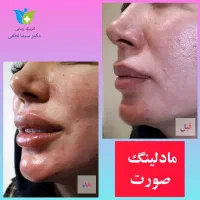 تزریق ژل بوتاکس جوانسازی پی آر پی کربوکسی و لاغری|خدمات آرایشگری و زیبایی|قزوین, |دیوار