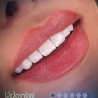 ایمپلنت دندان اقساط ویژه