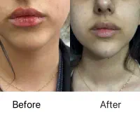 خدمات فیلر و بوتاکس و PRP با قیمت ویژه