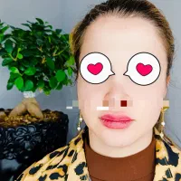 آف ویژ نوروز ،تزریق ژل و بوتاکس