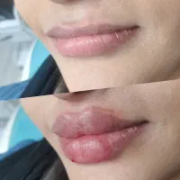 تزریقات ژل و بوتاکس((صفر تا صد جوانسازی ))