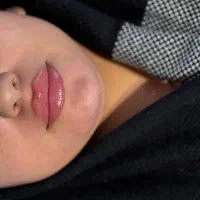 ژل بوتاکس پی ارپی پی آر اف در مطب زیبایی|خدمات زیبایی و سلامت|تبریز, |دیوار