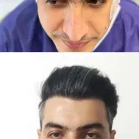 کاشت طبیعی وپرتراکم