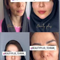 ساکشن غبغب وتزریق چربی بصورت و هرناحیه ازبدن درمطب|خدمات آرایشگری و زیبایی|قم, زنبیل آباد|دیوار