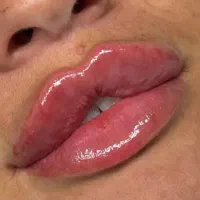 خدمات و تزریقات ژل و بوتاکس زیر قیمت