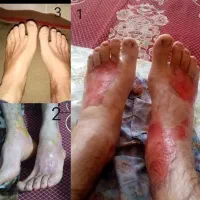 پماد سوختگی گیاهی صدرصد  تضمینی