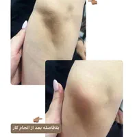 ریموتتوروشن کردن نواحی تیره درمان لک|خدمات آرایشگری و زیبایی|قم, باجک دو|دیوار
