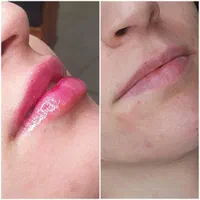 جشنواره تزریق فیلر و ژل زیبایی با قیمت فوق العاده