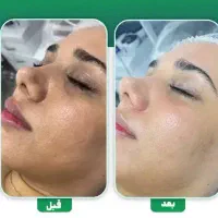 پاکسازی و فیشیال تخصصی صورت