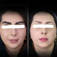 اقساطی/کاشت مو تضمینی/کاشت ابرو/ژل لب|خدمات آرایشگری و زیبایی|سنندج, |دیوار