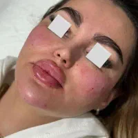ساکشن چربی ،تزریق چربی ، تزریق ژل ،فیلر لب بلفارو|خدمات آرایشگری و زیبایی|خرم‌آباد, |دیوار