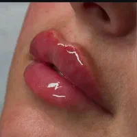 ژل و بوتاکس