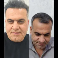 کاشت مو وابروی تخصصی به روش سوپر میکرو گرفت