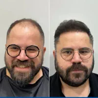 جشنواره پاییزه کاشت مو و کاشت ابرو|خدمات آرایشگری و زیبایی|تهران, دردشت|دیوار