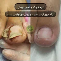 درمان ناخن فرورفته درگوشت بدون جراحی در کلینیک|خدمات آرایشگری و زیبایی|ورامین, خیر آباد|دیوار