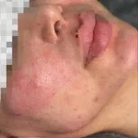 جشنواره ژل بوتاکس فقط روز جمعه