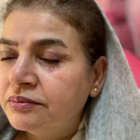 بلفاروپلاستی پلک بالا به مدت محدود فقط 8 میلیون|خدمات آرایشگری و زیبایی|بوکان, |دیوار