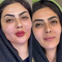 تخفیفات باور نکردنی ژل،آنزیم،بوتاکس،پاکسازی صورت