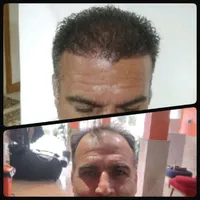 کاشت مو و ریش تحت نظر پزشک متخصص|خدمات آرایشگری و زیبایی|بابل, |دیوار
