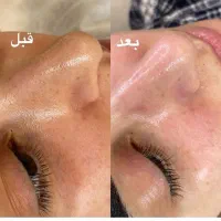 پاکسازی فیشیال صورت باتخفیف بی‌نظیر