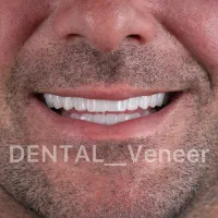 کامپوزیت دندان   تکنیک لیرینگ    لمینت ( اقساط)|خدمات آرایشگری و زیبایی|تهران, قیطریه|دیوار
