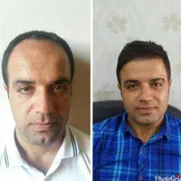 کاشت مو وابرو