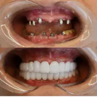 ایمپلنت باروکش رایگان فقط ۱۳۹۰۰/ دندانپزشکی