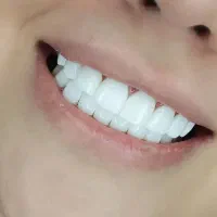 کامپوزیت زیبایی دندان