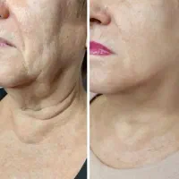 کرم ضدچین و چروک بسیار قوی