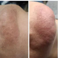 الکترولیز حذف دائم موهای سفید صورت