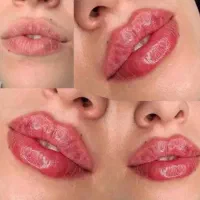 نیاز به مدل زیر ۳۰ سال جهت تزریق ژل لب