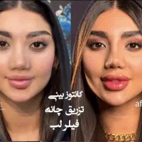 تزریق ژل بوتاکس وانزیم فیلر بینی ۶۹۹