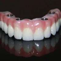 دندانپزشکی اوردنچر دوفک فقط ۱۰۰تومن درتبریز باوام|خدمات آرایشگری و زیبایی|آذرشهر, |دیوار