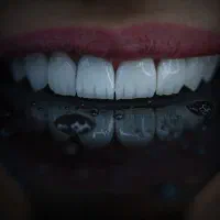 جشنواره پاییزه کامپوزیت،لمینیت،ایمپلنت اقساط