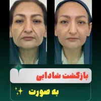 فیلر،بوتاکس،مزوتراپی،درمان منافذ باز و لک|خدمات آرایشگری و زیبایی|مشهد, وکیل‌آباد|دیوار