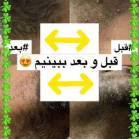 درمان قطعی زگیل