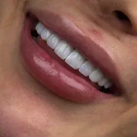 بمب تخفیفات کامپوزیت دندان