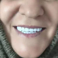 دندان منصوعی (دندان سازی)