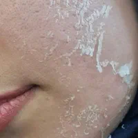 فیشال،درمان لک و تیرگی بدن،فشیال،مزونیدلینگ،پلاژن|خدمات آرایشگری و زیبایی|کرمانشاه, |دیوار