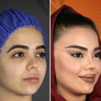 مدل زیبا وجوانسازی شفاف سازی لیف صورت به مدت محدود
