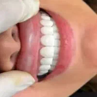 کامپوزیت دندان بابل|خدمات آرایشگری و زیبایی|امیرکلا, |دیوار