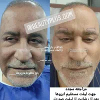 تخفیف ساکشن شکم پهلو و پشت/ هر ناحیه از بدن/بلفارو|خدمات آرایشگری و زیبایی|قم, زنبیل آباد|دیوار