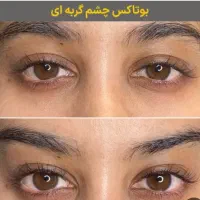 بوتاکس ژل صورت و بدن|خدمات آرایشگری و زیبایی|بیرجند, |دیوار