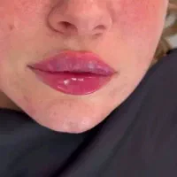 تزریقات ژل و بوتاکس و آنزیم