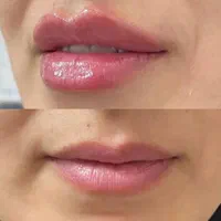 لیزر مو زائد/هایفو تراپی/ژل لب/تزریق چربی/بوتاکس|خدمات آرایشگری و زیبایی|اصفهان, جلفا|دیوار