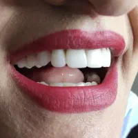 دندان لمینتی متحرک شرایطی تحویل کمترین زمان