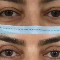 جراحی بلفاروپلاستی|خدمات آرایشگری و زیبایی|تهران, ده‌ونک|دیوار